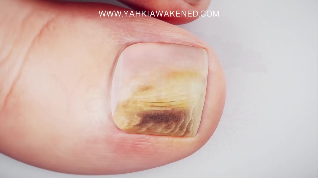 Nail Fungus and how to Get Rid of It