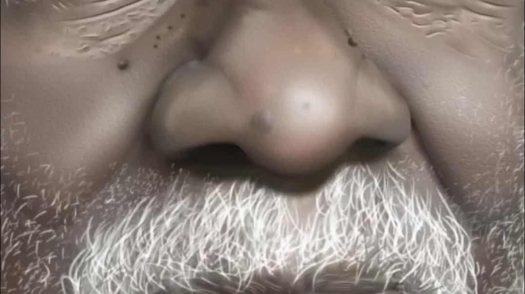 ⁣Hidradenitis Suppurativa Is The Body Way Of Protecting Itself From The Systemic Metabolic Acidosis⁉️